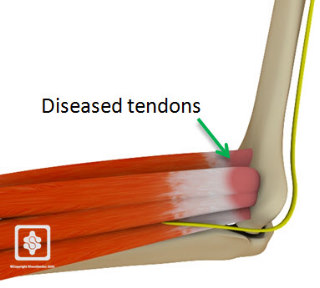 3D_golfers_elbow01