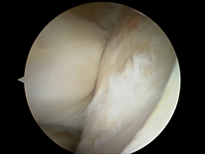 biceps bursoscopy scope view