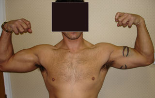 biceps distal tendon repair op year shoulderdoc wound result