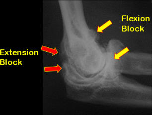 elbow_stiff01