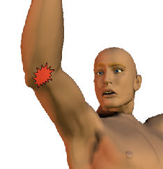 golfers_elbow_man