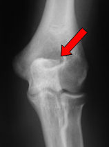olecranon_spur_posterior_imping_01